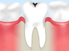 初期の虫歯なら削らず治せる場合もあります