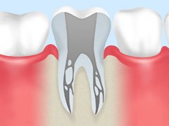 重度の虫歯を抜かずに治す「根管治療」