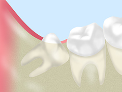 奥歯の痛みは親知らずが原因かもしれません