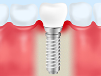 インプラントでも歯周病には注意が必要です