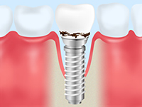 インプラントでも歯周病には注意が必要です