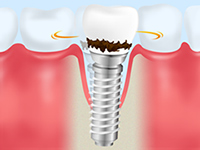 インプラントでも歯周病には注意が必要です